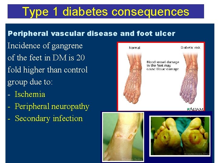 Type 1 diabetes consequences Peripheral vascular disease and foot ulcer Incidence of gangrene of