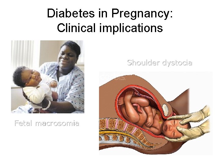Diabetes in Pregnancy: Clinical implications Shoulder dystocia Fetal macrosomia 