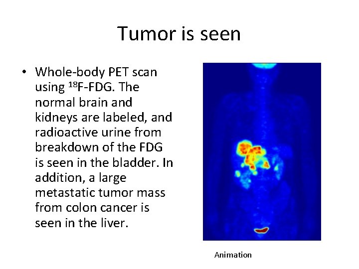 Tumor is seen • Whole-body PET scan using 18 F-FDG. The normal brain and