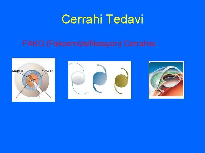 Cerrahi Tedavi FAKO (Fakoemülsifikasyon) Cerrahisi 