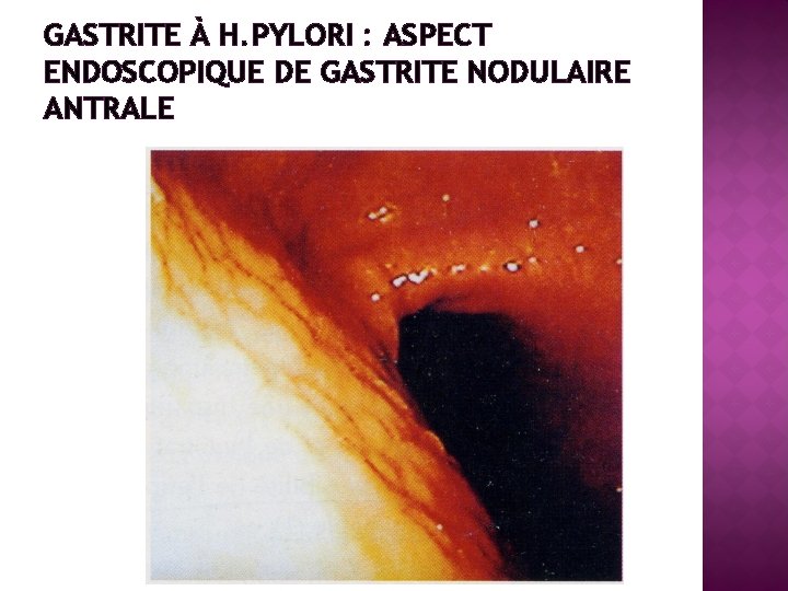 GASTRITE À H. PYLORI : ASPECT ENDOSCOPIQUE DE GASTRITE NODULAIRE ANTRALE 