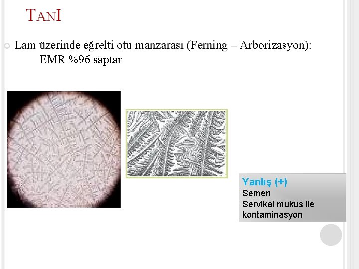 TANI Lam üzerinde eğrelti otu manzarası (Ferning – Arborizasyon): EMR %96 saptar Yanlış (+)