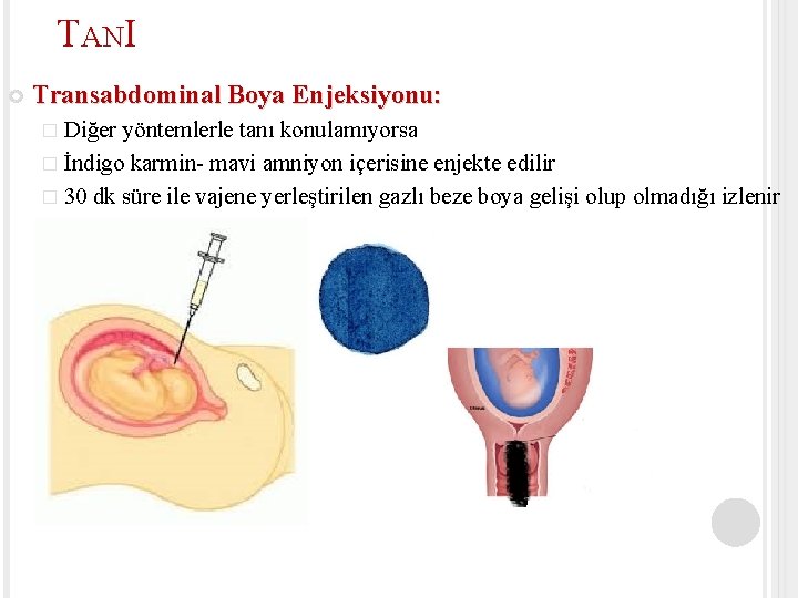 TANI Transabdominal Boya Enjeksiyonu: � Diğer yöntemlerle tanı konulamıyorsa � İndigo karmin- mavi amniyon