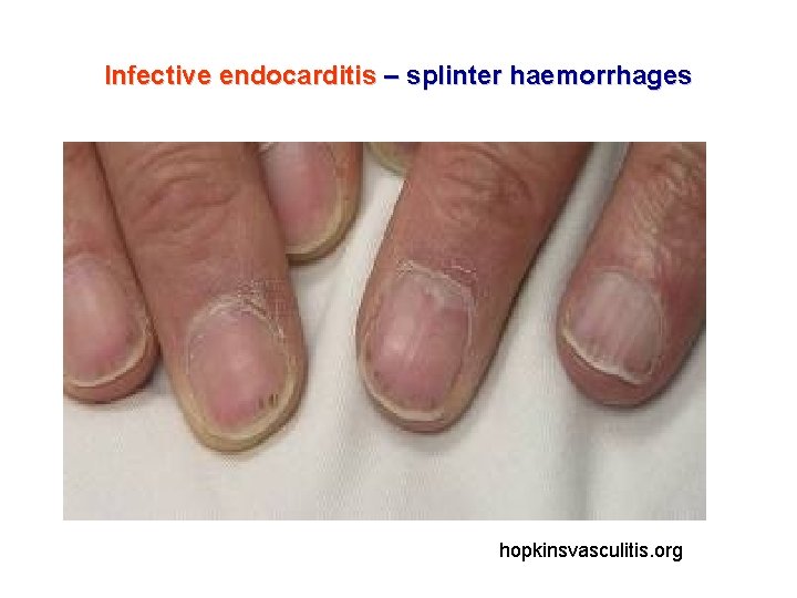 Infective endocarditis – splinter haemorrhages hopkinsvasculitis. org 