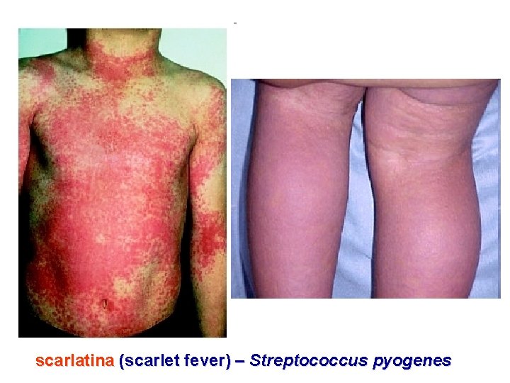scarlatina (scarlet fever) – Streptococcus pyogenes 