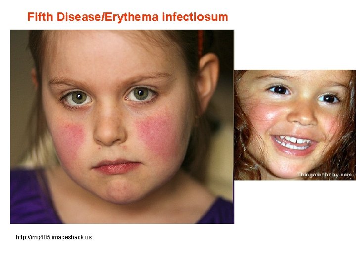 Fifth Disease/Erythema infectiosum http: //img 405. imageshack. us 