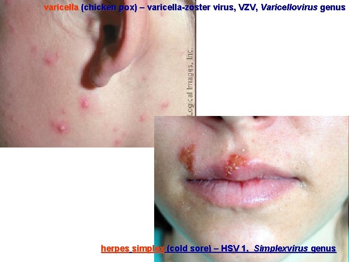 varicella (chicken pox) – varicella-zoster virus, VZV, Varicellovirus genus herpes simplex (cold sore) –