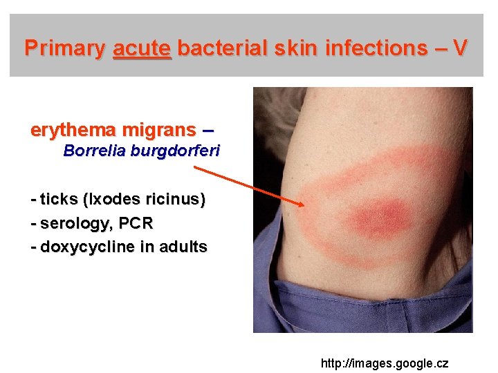 Primary acute bacterial skin infections – V erythema migrans – Borrelia burgdorferi - ticks