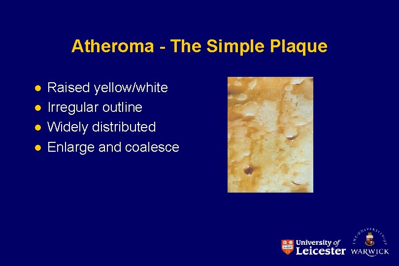 Atheroma - The Simple Plaque l l Raised yellow/white Irregular outline Widely distributed Enlarge
