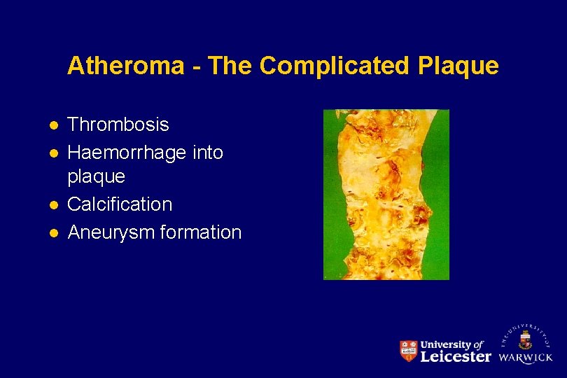 Atheroma - The Complicated Plaque l l Thrombosis Haemorrhage into plaque Calcification Aneurysm formation