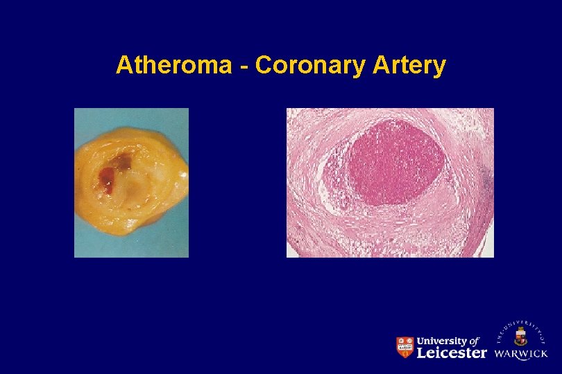 Atheroma - Coronary Artery 