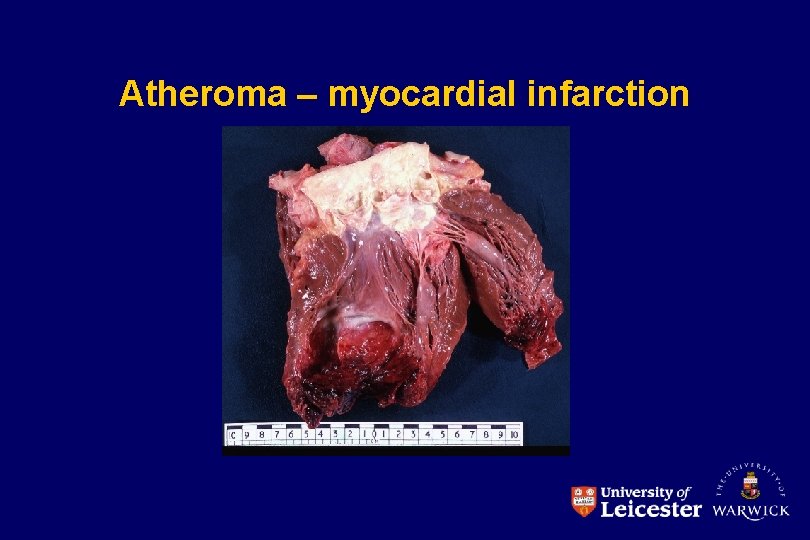 Atheroma – myocardial infarction 