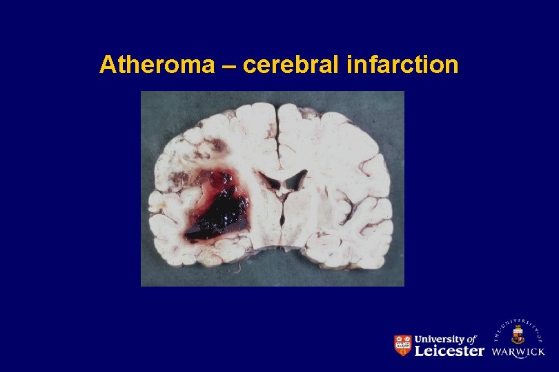 Atheroma – cerebral infarction 