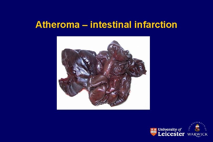 Atheroma – intestinal infarction 