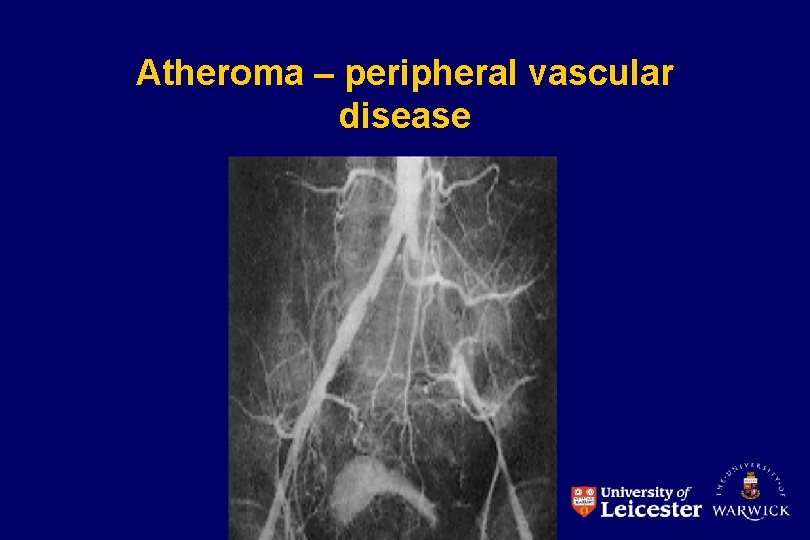 Atheroma – peripheral vascular disease 