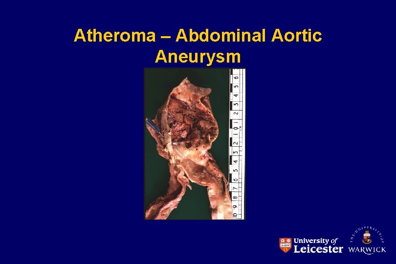 Atheroma – Abdominal Aortic Aneurysm 