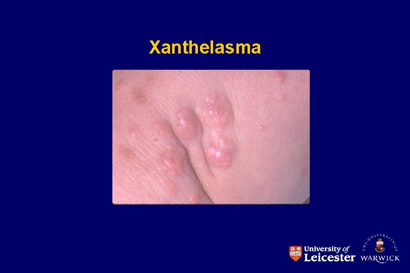 Xanthelasma 