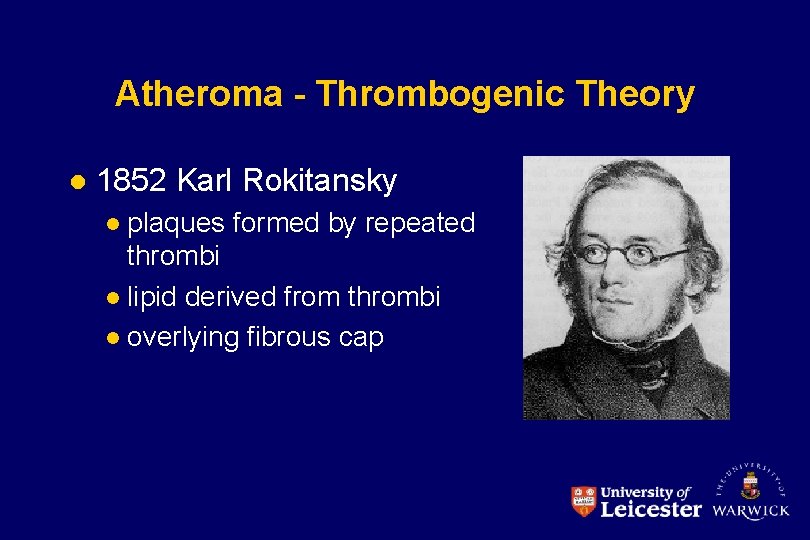 Atheroma - Thrombogenic Theory l 1852 Karl Rokitansky plaques formed by repeated thrombi l