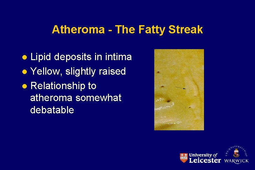 Atheroma - The Fatty Streak Lipid deposits in intima l Yellow, slightly raised l