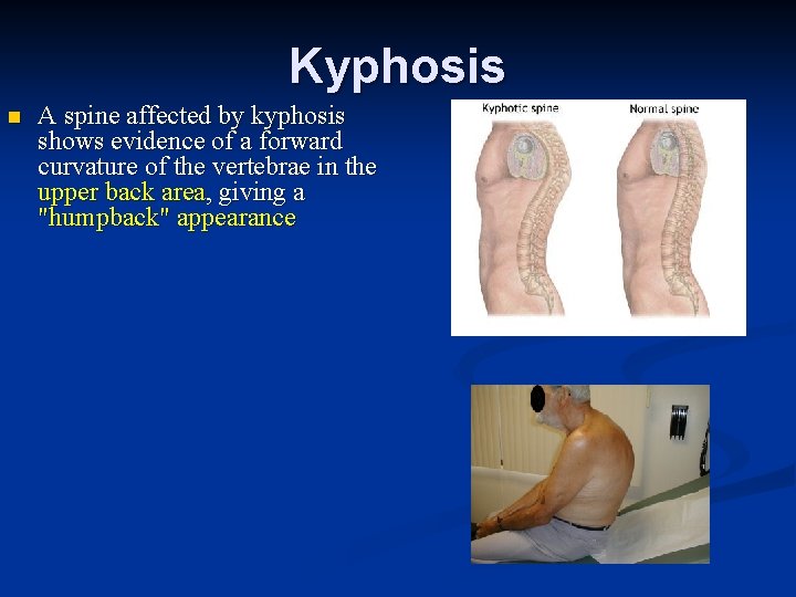 Kyphosis n A spine affected by kyphosis shows evidence of a forward curvature of