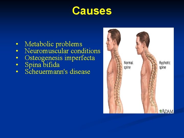 Causes • • • Metabolic problems Neuromuscular conditions Osteogenesis imperfecta Spina bifida Scheuermann's disease