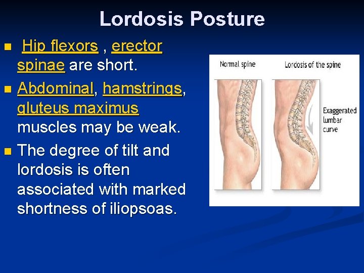 Lordosis Posture Hip flexors , erector spinae are short. n Abdominal, hamstrings, gluteus maximus