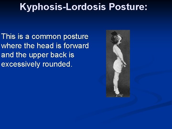 Kyphosis-Lordosis Posture: This is a common posture where the head is forward and the