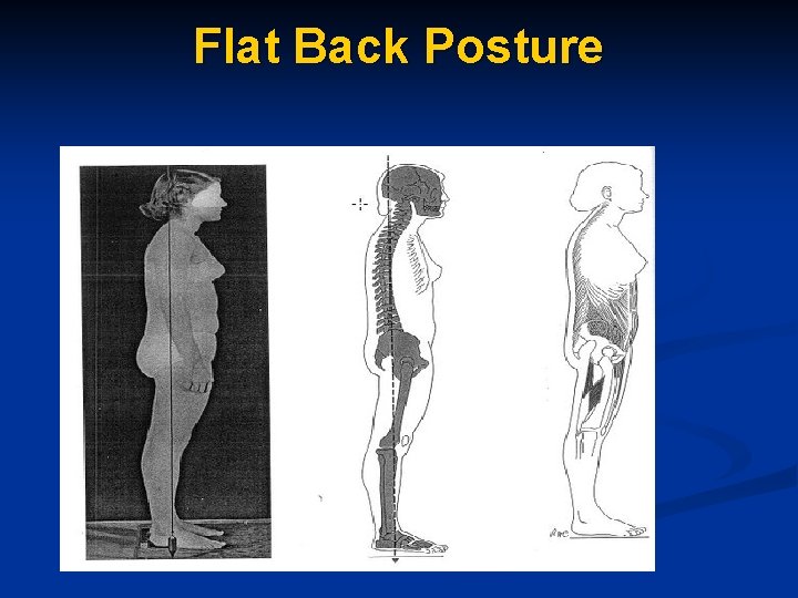 Flat Back Posture 