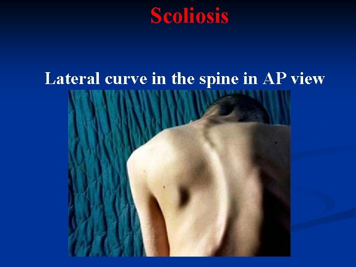 Scoliosis Lateral curve in the spine in AP view 