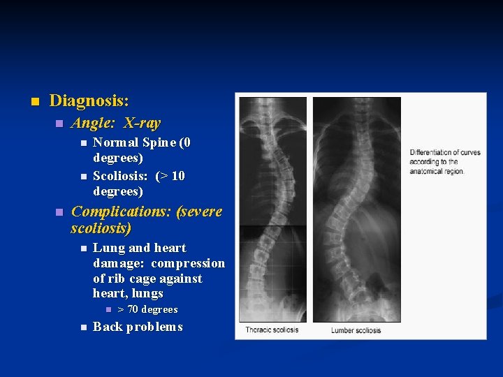 n Diagnosis: n Angle: X-ray n n n Normal Spine (0 degrees) Scoliosis: (>
