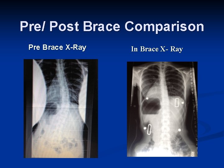 Pre/ Post Brace Comparison Pre Brace X-Ray In Brace X- Ray 