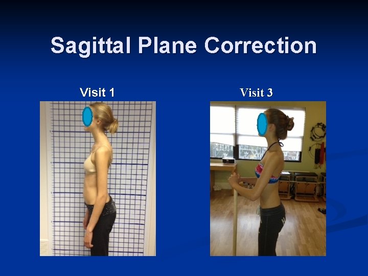 Sagittal Plane Correction Visit 1 Visit 3 