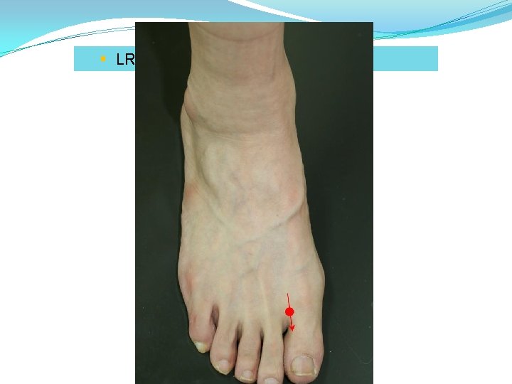 § LR 2 (行間): fire point of liver channel 