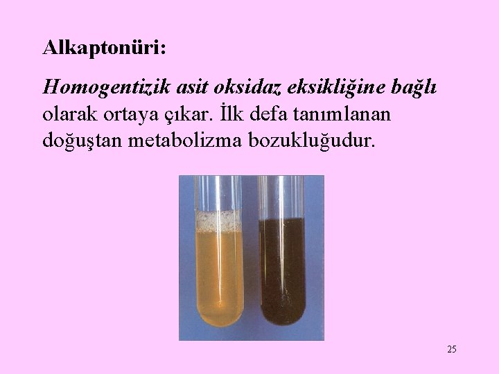 Alkaptonüri: Homogentizik asit oksidaz eksikliğine bağlı olarak ortaya çıkar. İlk defa tanımlanan doğuştan metabolizma