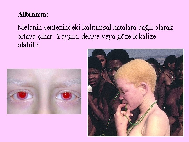 Albinizm: Melanin sentezindeki kalıtımsal hatalara bağlı olarak ortaya çıkar. Yaygın, deriye veya göze lokalize