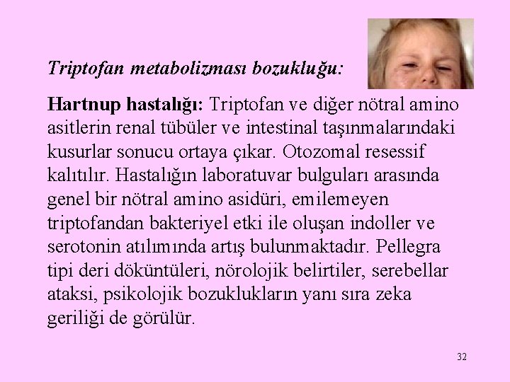 Triptofan metabolizması bozukluğu: Hartnup hastalığı: Triptofan ve diğer nötral amino asitlerin renal tübüler ve