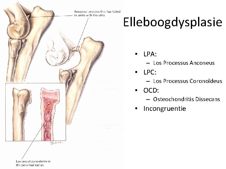 Elleboogdysplasie • LPA: – Los Processus Anconeus • LPC: – Los Processus Coronoïdeus •