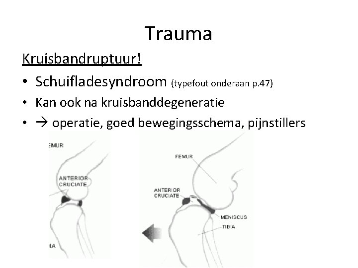 Trauma Kruisbandruptuur! • Schuifladesyndroom (typefout onderaan p. 47) • Kan ook na kruisbanddegeneratie •