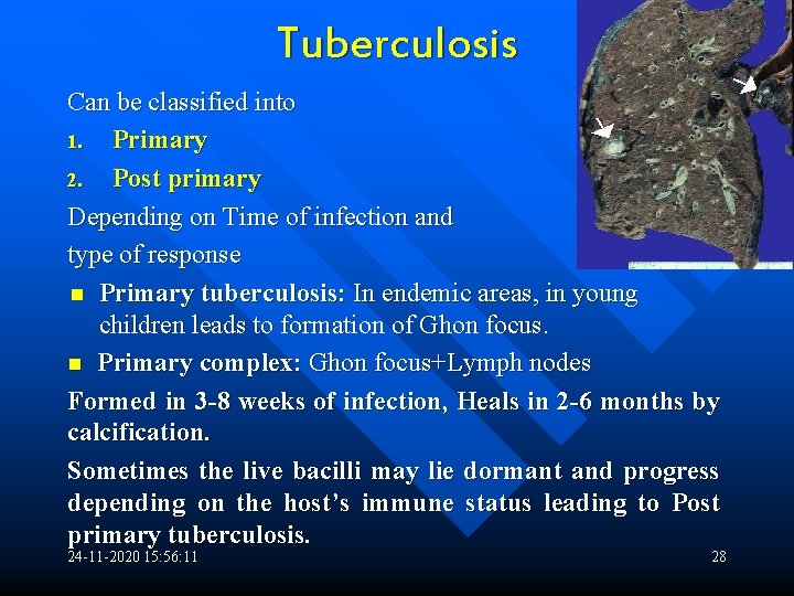 Tuberculosis Can be classified into 1. Primary 2. Post primary Depending on Time of