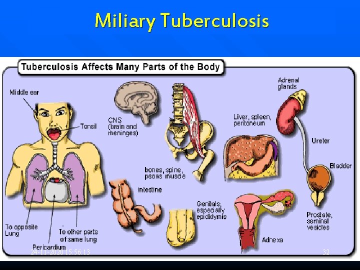 Miliary Tuberculosis 24 -11 -2020 15: 56: 13 32 