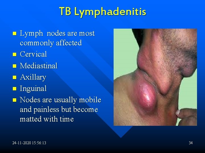 TB Lymphadenitis n n n Lymph nodes are most commonly affected Cervical Mediastinal Axillary