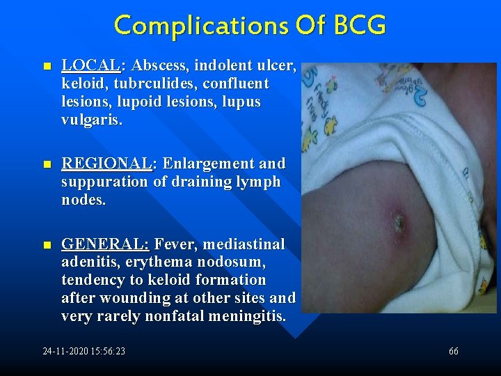 Complications Of BCG n LOCAL: Abscess, indolent ulcer, keloid, tubrculides, confluent lesions, lupoid lesions,