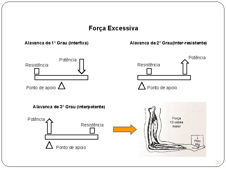 Força Excessiva Alavanca de 1º Grau (interfixa) Alavanca de 2º Grau(Inter-resistente) Potência Resistência Ponto