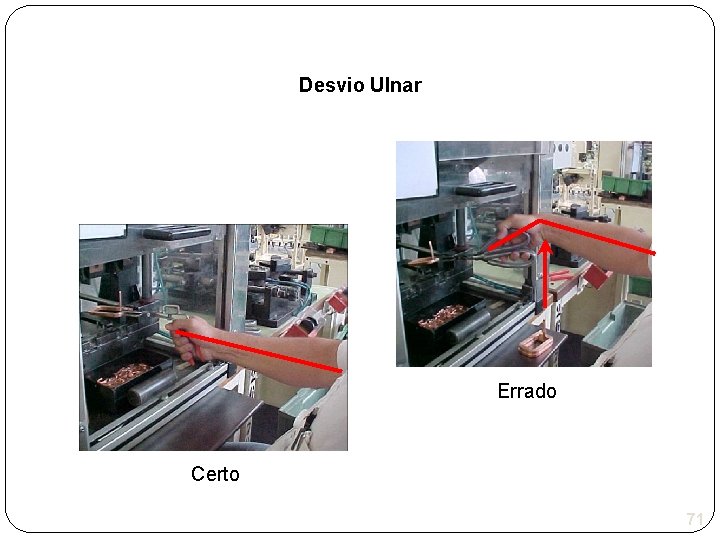 Desvio Ulnar Errado Certo 71 