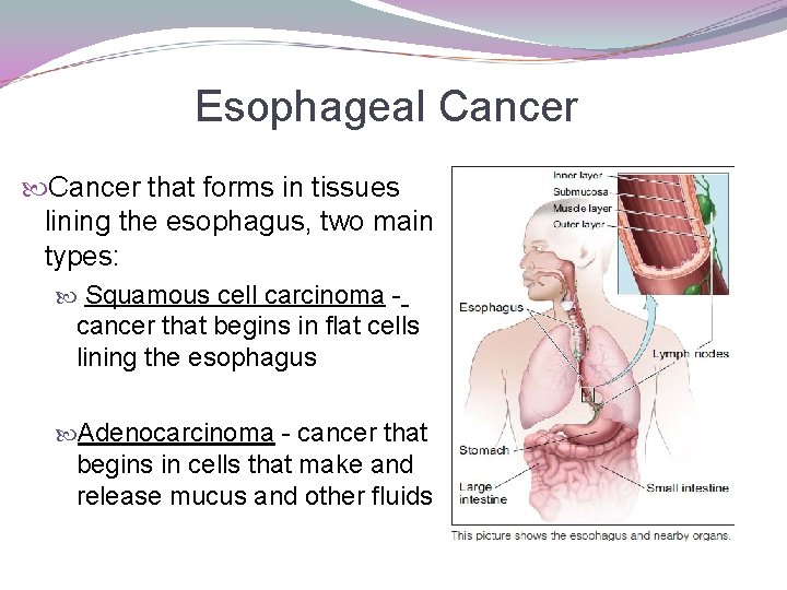 Esophageal Cancer that forms in tissues lining the esophagus, two main types: Squamous cell