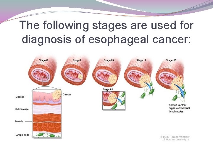 The following stages are used for diagnosis of esophageal cancer: 