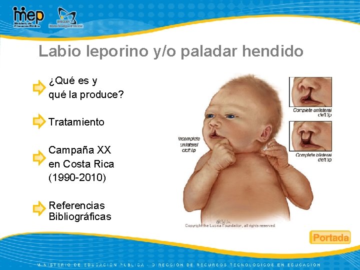 Labio leporino y/o paladar hendido ¿Qué es y qué la produce? Tratamiento Campaña XX
