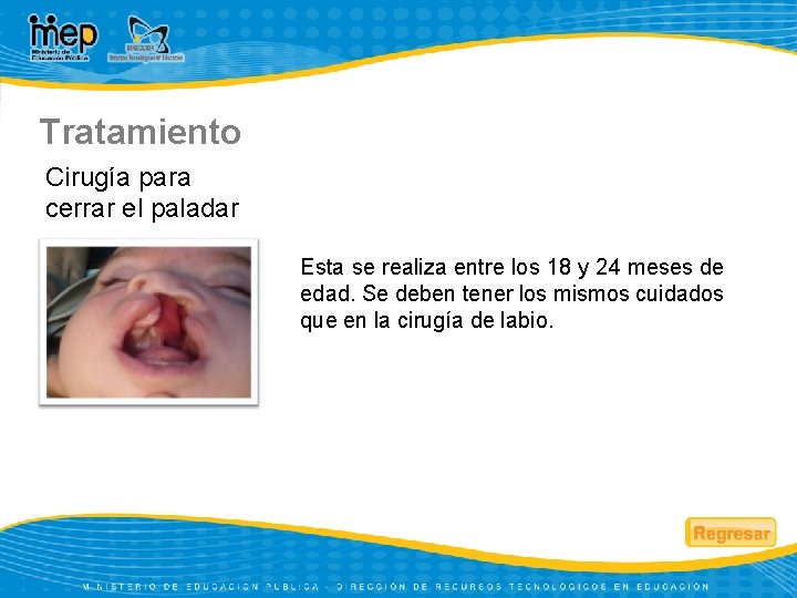 Tratamiento Cirugía para cerrar el paladar Esta se realiza entre los 18 y 24