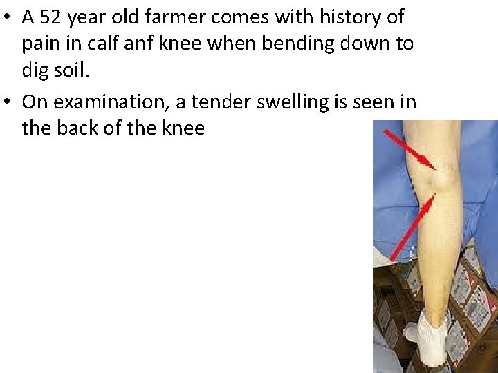  • A 52 year old farmer comes with history of pain in calf