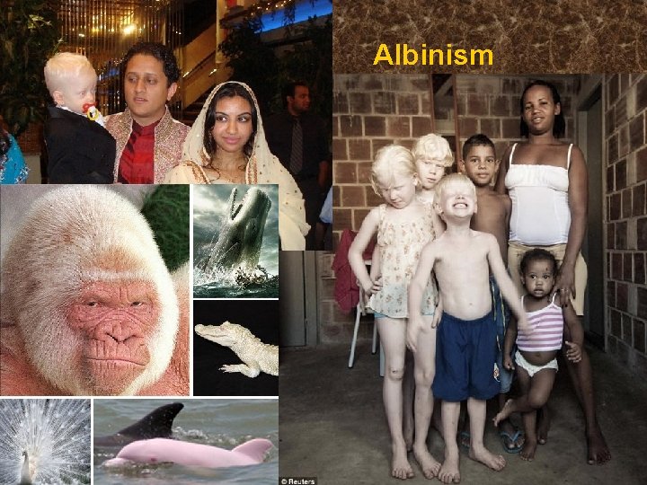 Albinism 